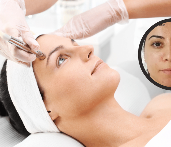 microdermabrasion vorher nachher